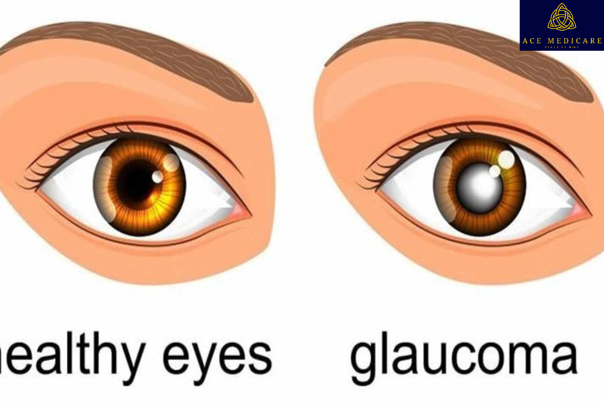 The Role of Medication in Managing Glaucoma: What You Need to Know